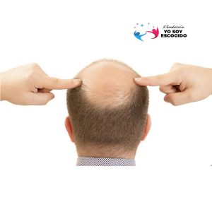 Calvicie - Tratamiento para Hombres
