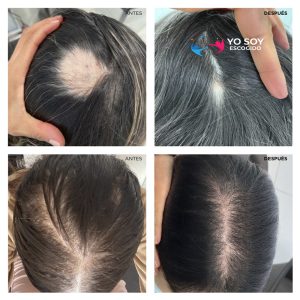 Calvicie - Tratamiento para Mujeres