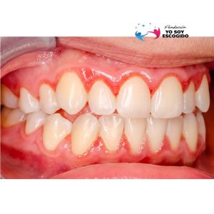 Gengivitis - Tratamiento para Sangrado e Inflamación