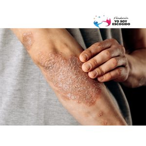 Psoriasis - Eliminala por Completo (Tratamiento)