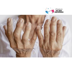 Artritis Rematoidea - Tratamiendo